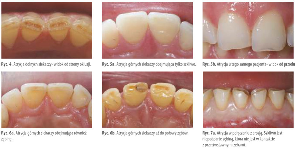 Choroba Okluzyjna Najczęstszy Powód Utraty Zębów Akademia Dawsona 3656